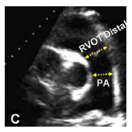 <p>Main Pulmonary artery is measured inner edge to inner edge at end diastole at the mid point. </p><p>Abnormal is > 2.0 cm</p>