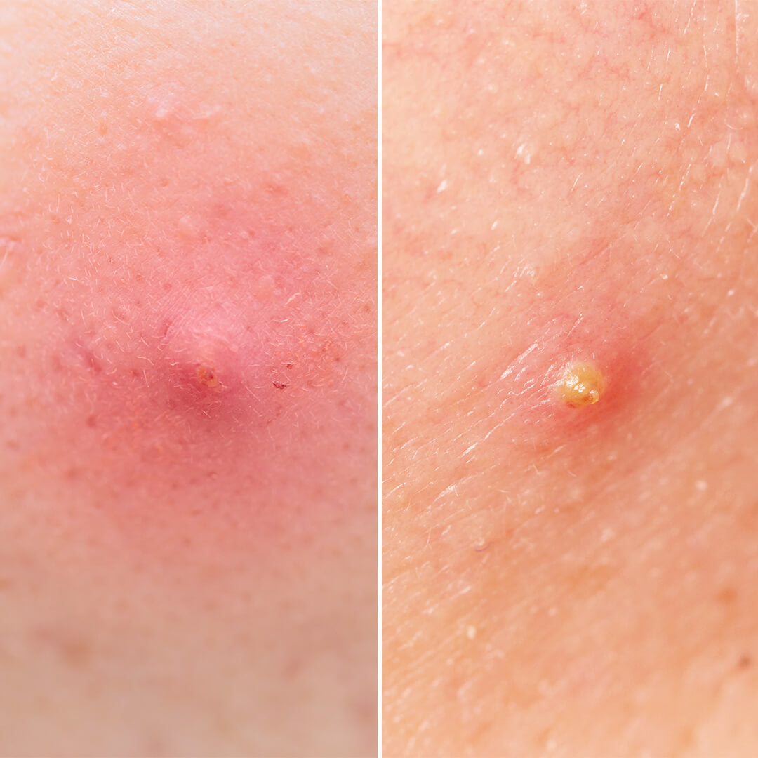 <p>elevated lesion with no visible pus (similar to pustule) </p>