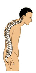 <p>excessive outward curvature of the spine, causing hunching of the back.</p>