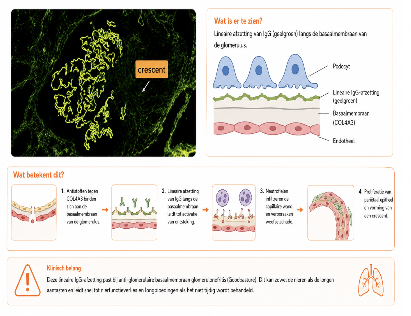 <ul><li><p>je ziet bij immunofluor weer IgG → maar nu is beeld niet onregelmatig, maar de complexen zitten juist in een strakke lijn die de contour van BM volgt </p></li><li><p>dus het is een ziekte die duidelijk gericht is tegen de bM </p></li><li><p>hierbij zijn antistoffen gericht tegen collageen type 4 (zit in BM) </p></li><li><p>maar type 4 zit ook in de long → als daar antistoffen tegen zijn = <strong>Goodpasture</strong> </p></li><li><p>je kunt op de kleuring BM goed volgen, behalve waar crescent dus zit </p></li><li><p>stel je ziet IgG1 en kappa → B cel lymfoom </p></li></ul><p></p>