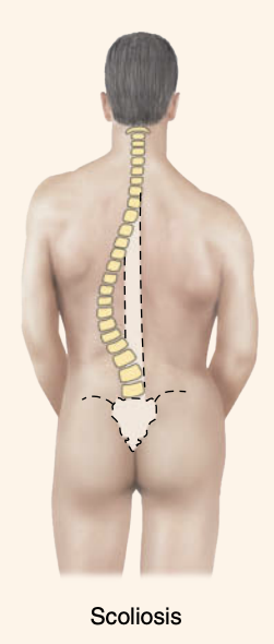 <p><strong>Abnormal Curves </strong></p><p>What is scoliosis?</p>