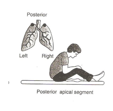 <p>posterior apical segment </p>