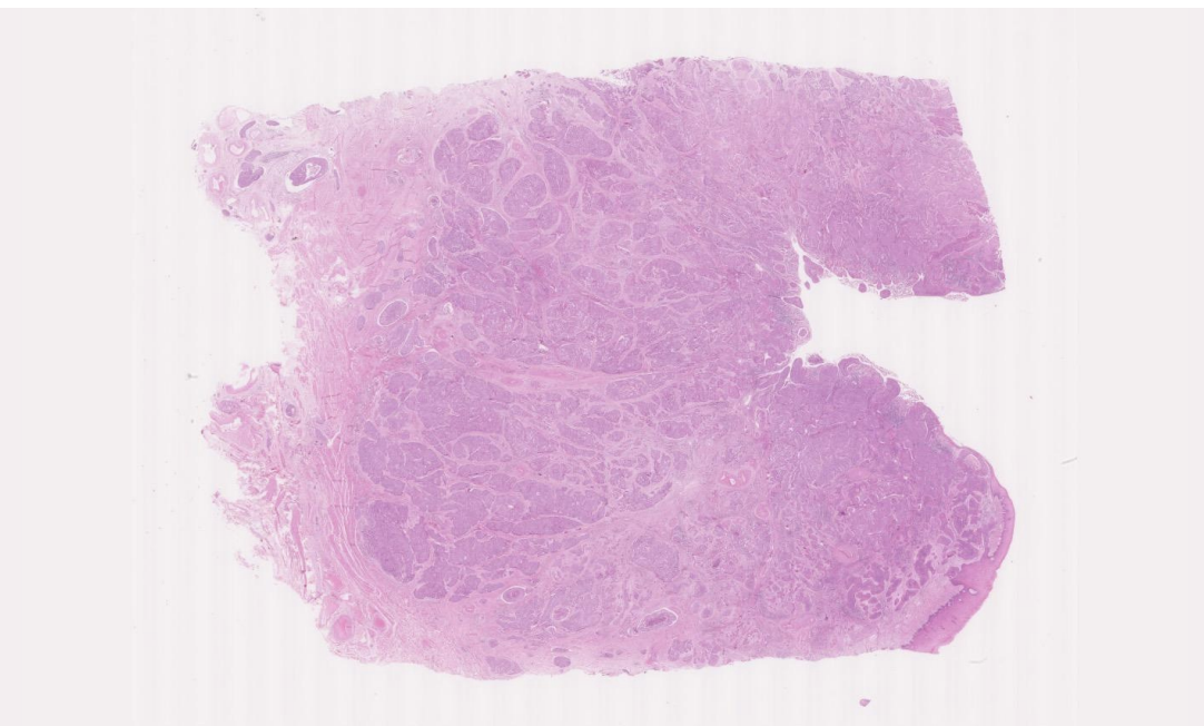 <p>Squamous Cell Carcinoma</p><p>Resected uterus of a 47 year old woman who had noticed some irregular vaginal bleeding. She had never had a cervical smear screening examination, but already had invasive carcinoma by the time she presented to her doctor. This is a squamous cell carcinoma of the cervix. </p>