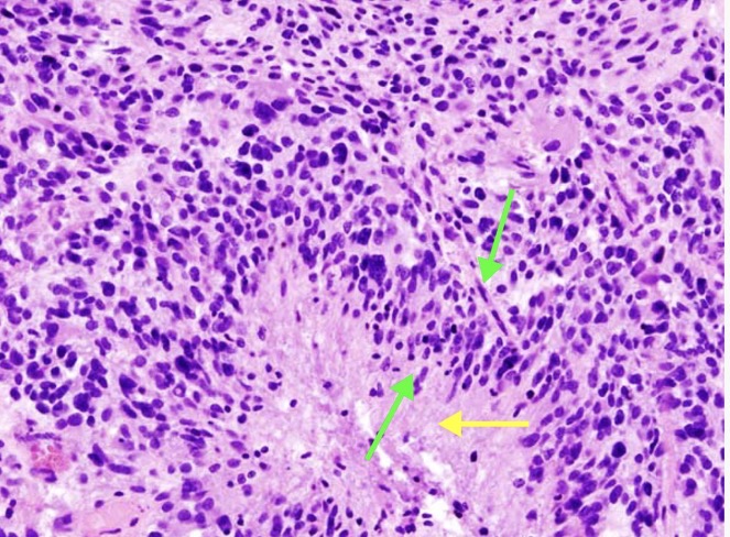 <p>New seizure, spreads both hemispheres, pseudopalsading pleomorphic tumor cells with central areas of necrosis and hemorrhage, GFAP protein, 64 something year old, personality changes, focal defects, cells from astrocytes </p>