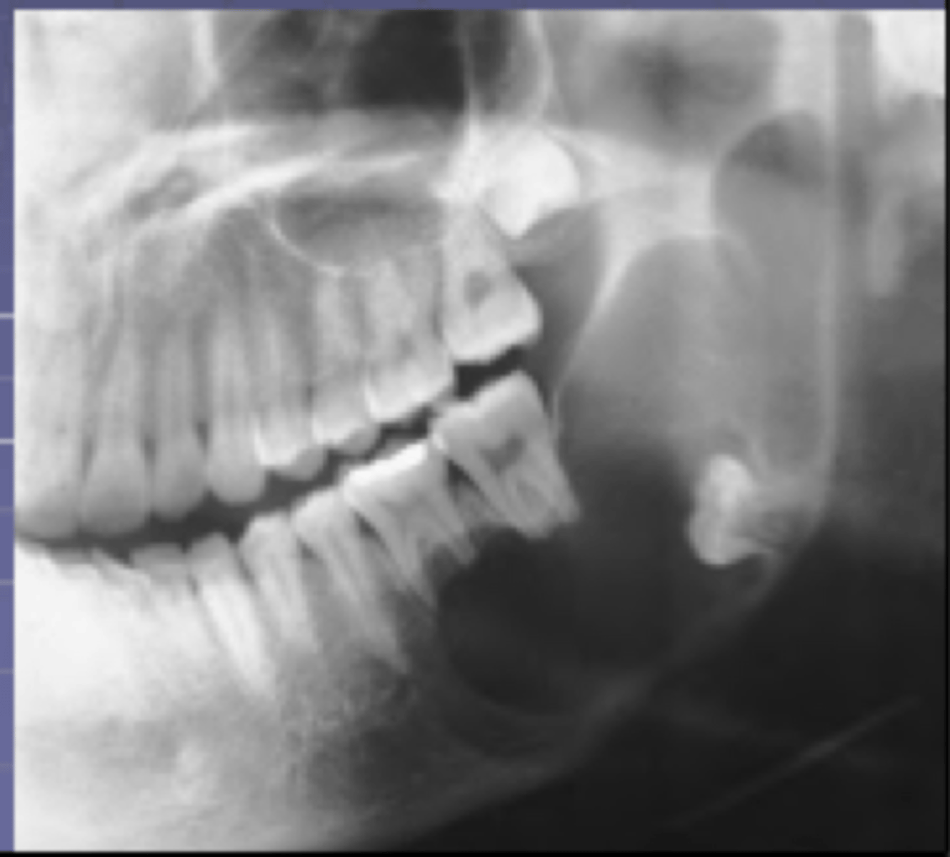 <p>-show multilocular radiolucencies in the molar areas if the mandible</p><p>-is benign, slow growing but locally aggressive epithelial odontogenic tumor that may arise in either the maxilla or the mandible</p><p>-it is a non encapsulated tumor that infiltrates into surrounding tissue and can cause extensive destruction</p>