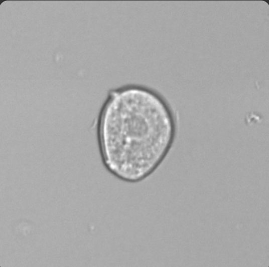 <p>Comes from Renal Pelvis/calyces/ureters/bladder</p><p>Increased post invasive procedure (Trauma/catheter)</p><p>Larger than WBCs, Central nucleus</p>