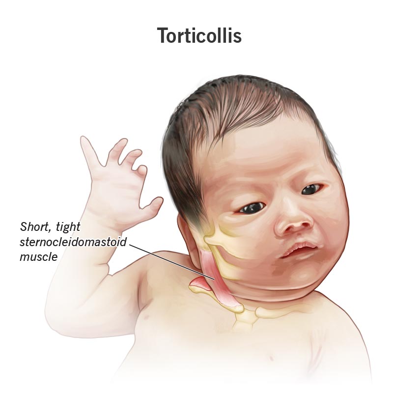 <p>head tilt from shortening or spasm of sternomastoid muscle</p>