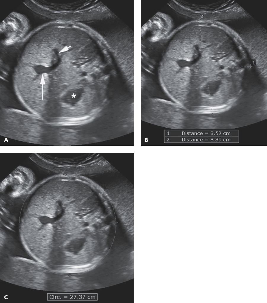 <p>axial view of the fetus and should include the fetal stomach, transverse thoracic spine, and intrahepatic portion of the umbilical vein and its junction with the left portal vein</p>