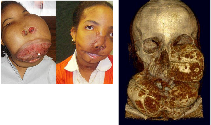 <p>polyostotic type</p>