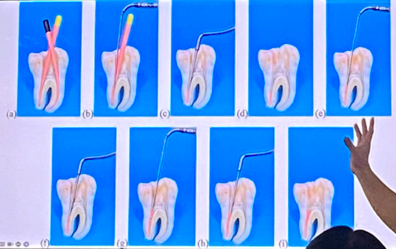 <p>involves softening gutta-percha using heat and compacting it vertically with a plugger</p>