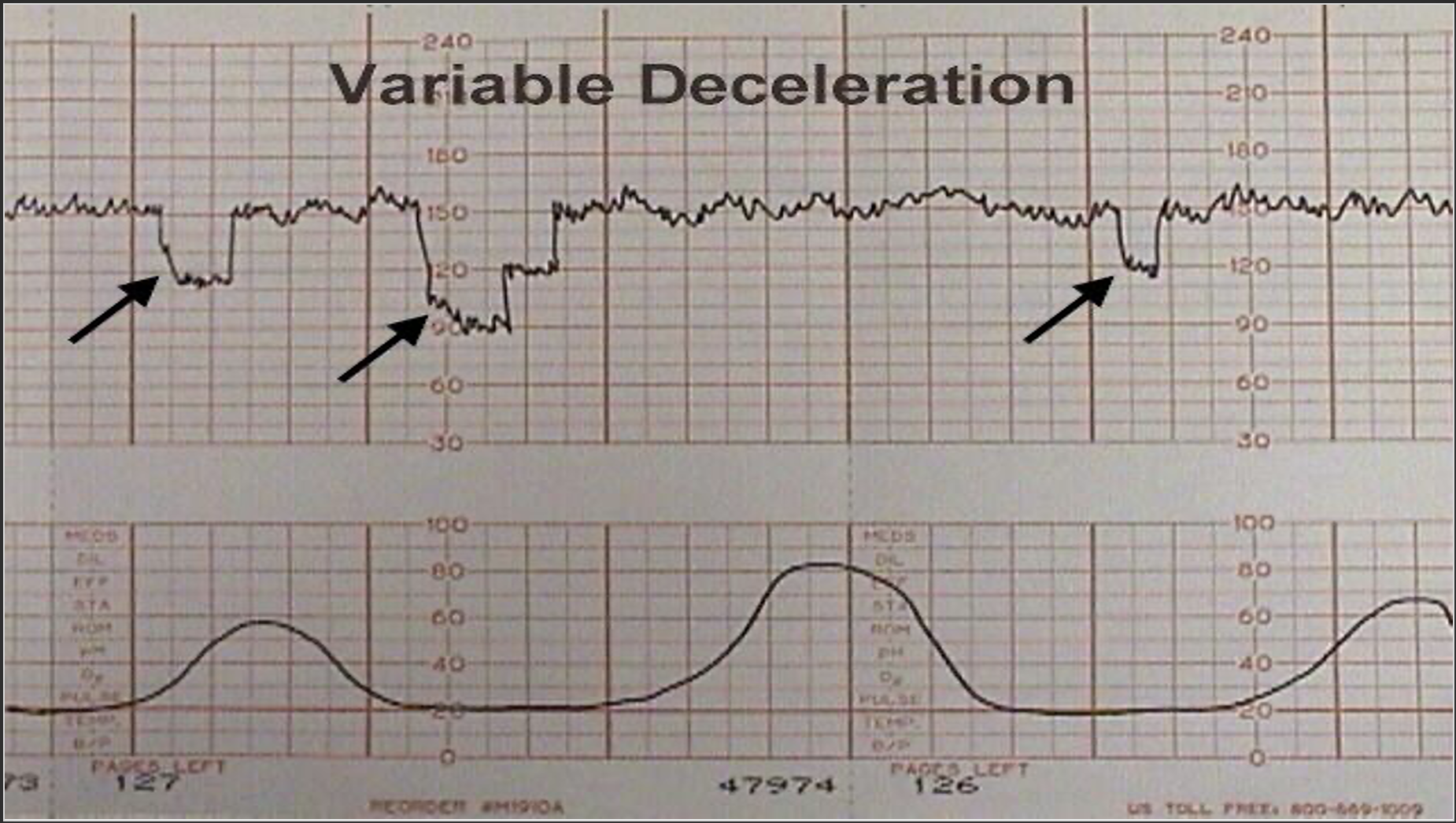 <p>Variable Deceleration</p>
