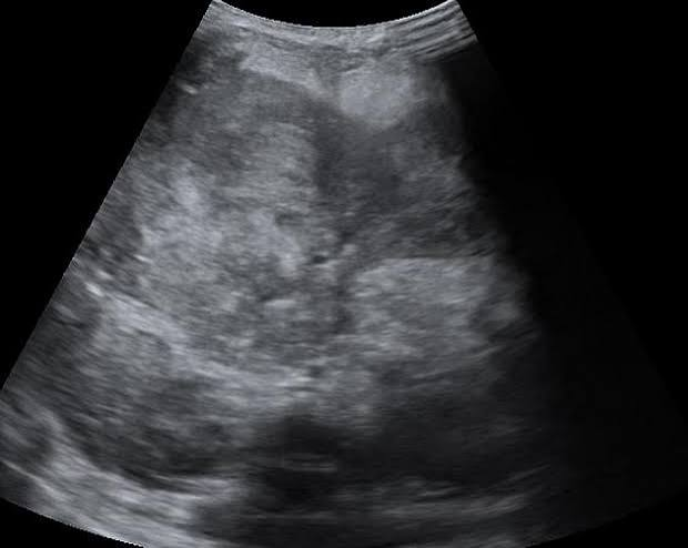 <p>heterogenous, hyperechoic, cystic, internal spetations</p>