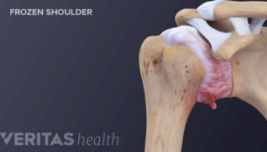 <p>Management for adhesive capsulitis</p>