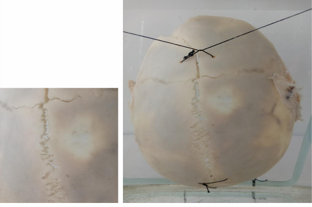 <p>Questions</p><ol><li><p>What are the specific path, descriptive features, and sutures involved in the fracture?</p></li><li><p>How is the antemortem nature of the injury determined?</p></li><li><p>What type of causative instrument and force mechanics produce this injury?</p></li><li><p>How is the time of death estimated?</p></li><li><p>What are the possible causes of death?</p></li><li><p>What is the final diagnosis for this specimen?</p></li></ol><div data-type="horizontalRule"><hr></div><p></p><p></p>