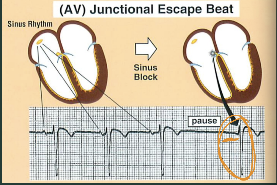 <p>What’s a junctional escape beat?</p>