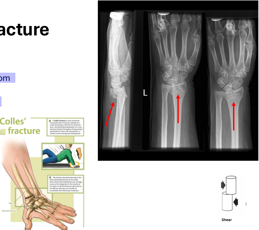 <p>Special: Colles’ Fracture</p>