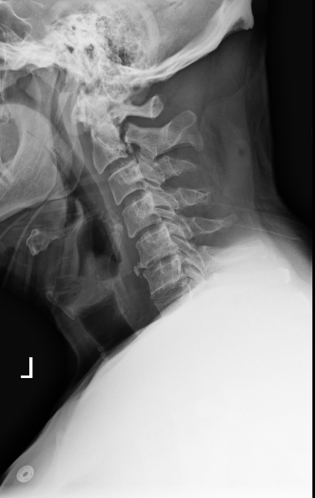 <p>MVA, what is the diagnosis?</p>