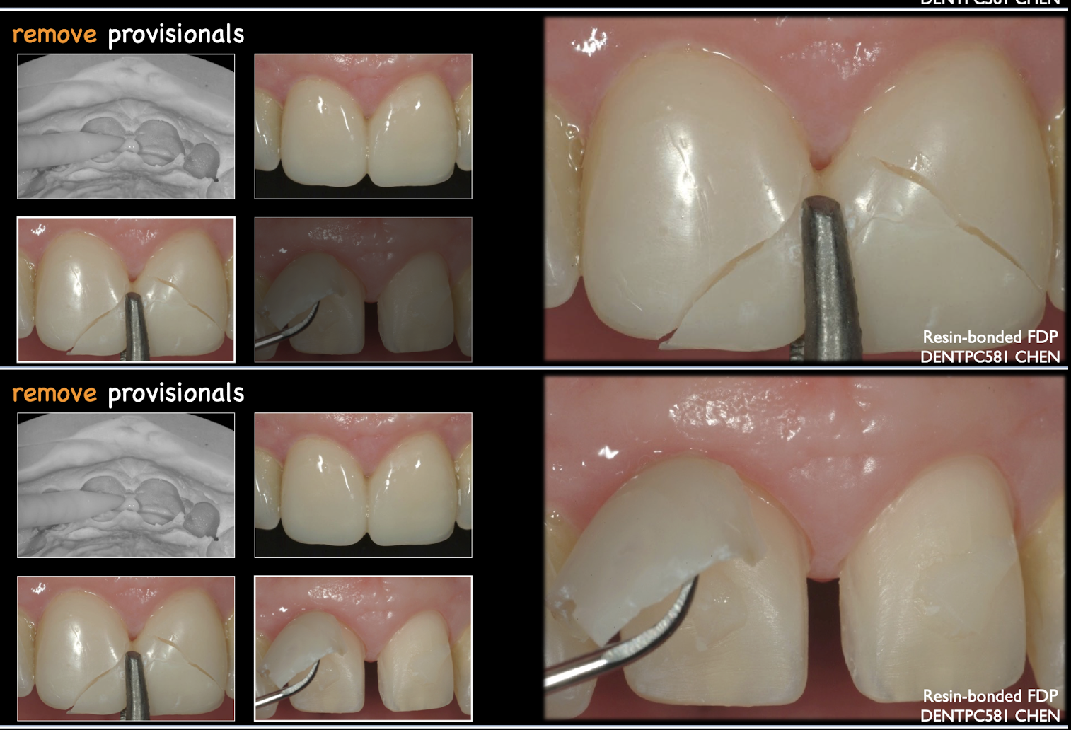 <p>after you remove the provisional on delivery day, what should you use to remove the residual bondings on the tooth </p>