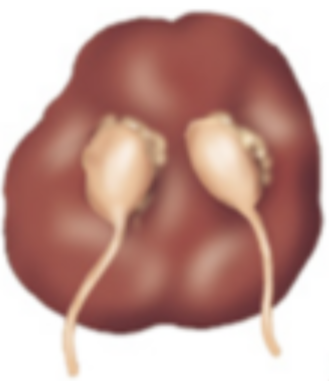 <p>What renal congenital anomaly is when the kidneys fuse completely and remain in the midline?</p>