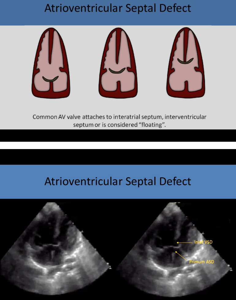 <p>as a single linear structure between ventricles and atria</p><p>(lack of normal offest of TV toward apex) </p>