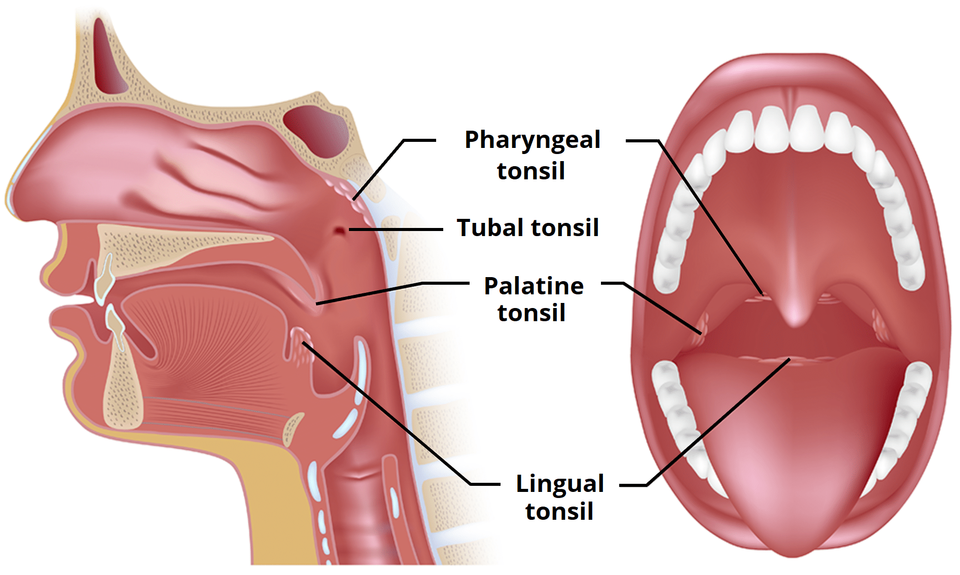 <p>Inflammation of the pharynx and tonsils</p>
