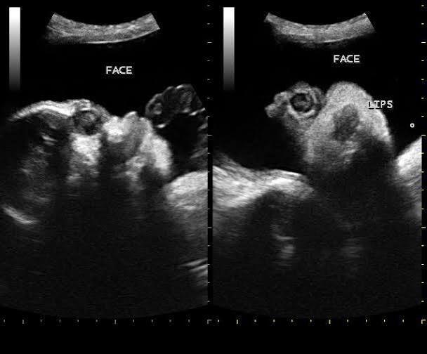 <p>single midline orbit </p><ul><li><p>associated with </p><ul><li><p>holoprosencephaly </p></li><li><p>trisomy 13</p></li><li><p>microcephaly </p></li><li><p>williams </p></li></ul></li></ul><p></p>