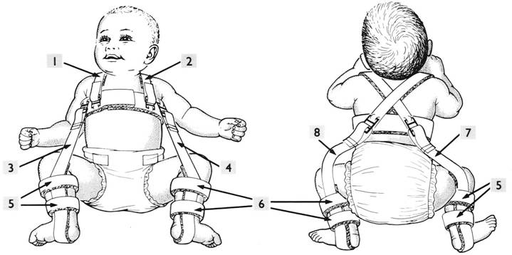 <ul><li><p>Pavlik harness</p></li><li><p>Frejka pillow</p></li></ul><p></p>