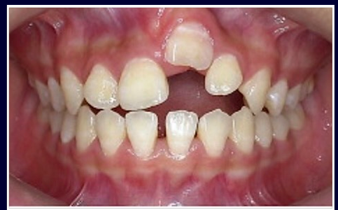 <p>-directly related to the damage of the PDL</p>