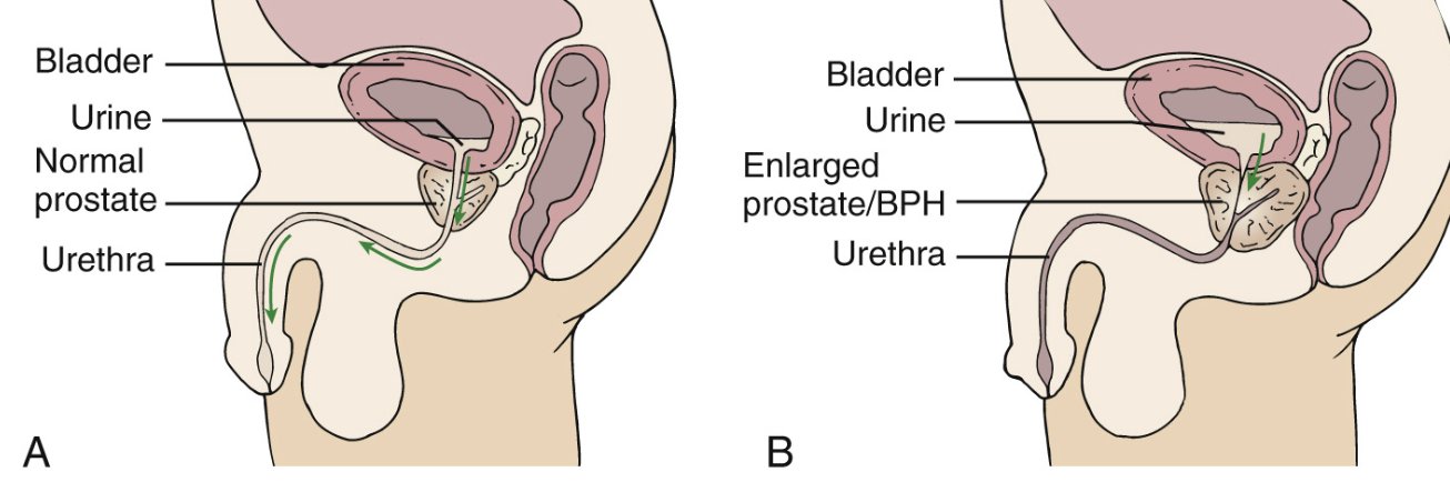 <p><span>The most common cause of LUTS is a benign (non-cancerous) increase in the size of the prostate: benign prostatic hyperplasia (BPH). </span></p><p><span>If you recall that the urethra passes through the prostate, it makes sense that if the prostate is enlarged, the urethra is narrowed creating a higher pressure to urinate against. </span></p>