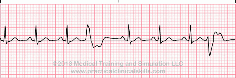 <p>Rate: depends on underlying rhythm</p><p>Regularity: irregular </p>