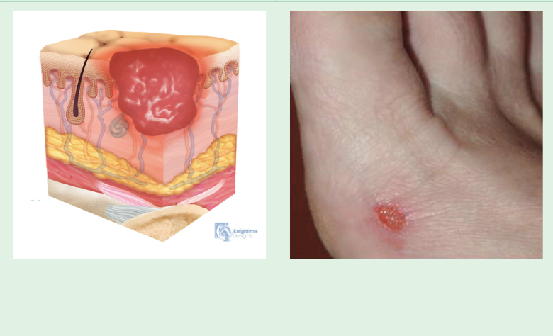 <p>Partial-thickness skin loss with <em>exposed</em> <em>dermis</em></p><ul><li><p>Wound bed = pink/red, moist, can appear as a blister</p></li><li><p>Adipose fat is NOT visible</p></li><li><p>NOT considered a moisture associated skin damage</p></li></ul><p></p>