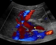 <p><span>Thrombus within the portal venous system</span></p>