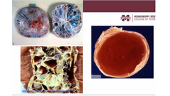 <p>What ovarian abnormality has this honeycomb appearance on US?</p>