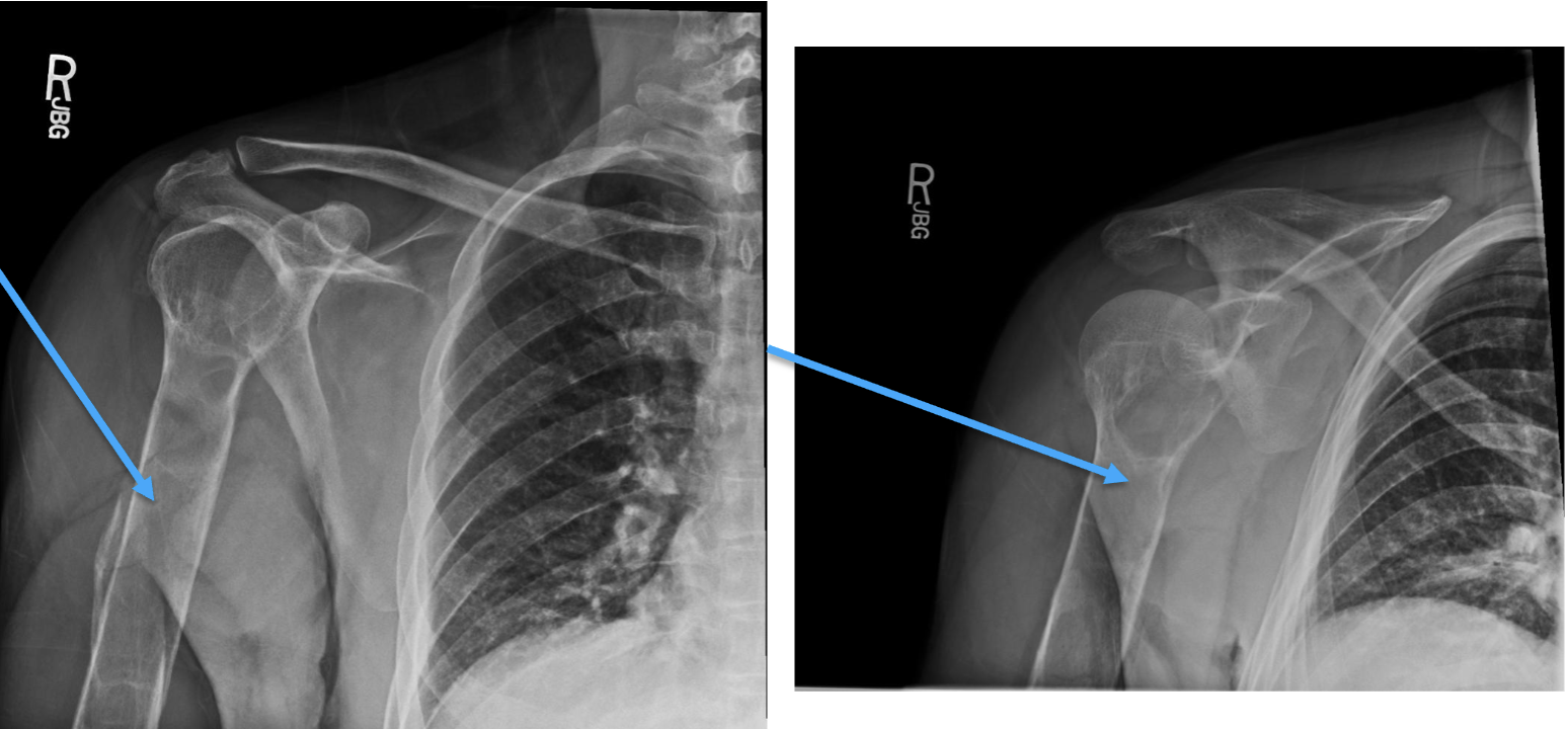 <p>What bone tumour is this, what bone is it in and what can be seen?</p>