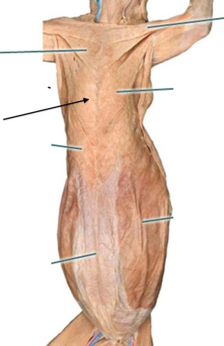 <p>Pectoralis minor</p>