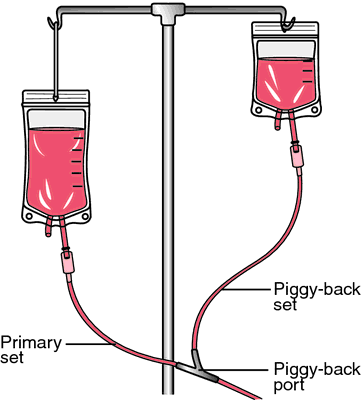 <p>medication prepared in a small volume of fluid is attached to an IV (which is already infusing fluid into a client’s vein) at specified times</p>
