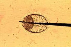 <p>1. Enucleation, 2. Extraction, 3. Insertion, 4. Development.</p>