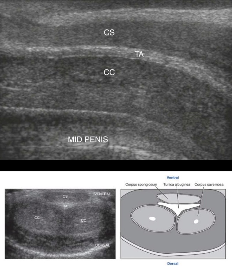 <p>Corpus Spongiosum: lies anterior to the paired corpus cavernosa; homogeneous texture composed of medium-level echoes</p><p>Tunica Albuginea: highly echogenic covering of the corpus cavernosa</p><p>Septum Penis: echogenic plane dividing the two corpora cavernosa; extension of the tunica albuginea</p><p>Paired Corpora Cavernosa: Lie posterior to the corpus spongiosum and appear symmetrical, round or oval, with a medium-level homogeneous echo texture</p>