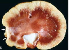 <p>Which chronicity is this renal infarct considered?</p>