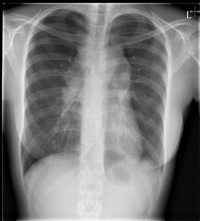 <p><span>Female, 30 years. Erythema nodosum and arthralgia. No other symptoms</span></p>
