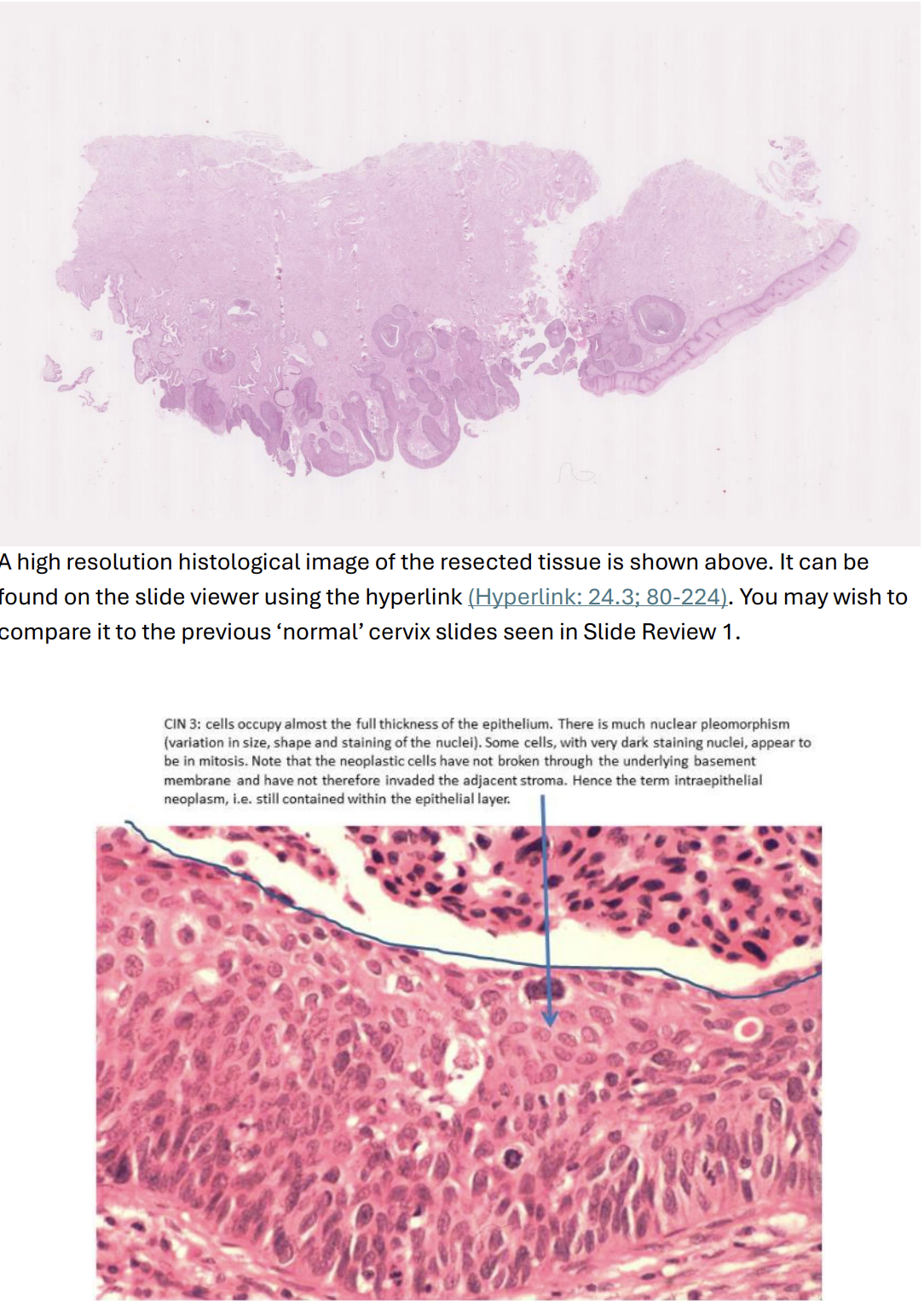 <p>After the discovery of abnormal cells in the cervical smear of a 39-year-old woman, her uterus was removed. A high power histological view of the resected cervical tissue includes an area of full-thickness dysplasia, confined to the epithelium (CIN 3). </p>