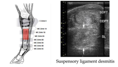 <p>What is mid body suspensory ligament desmitis?</p>