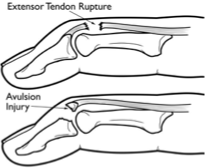 <p>What type of fracture is shown in the image?</p>