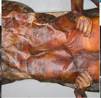 <p>Questions</p><ol><li><p>What postmortem change is characterized by these skin features?</p></li><li><p>What are the specific physical and color changes observed in the skin during this process?</p></li></ol><div data-type="horizontalRule"><hr></div><p></p><p></p>