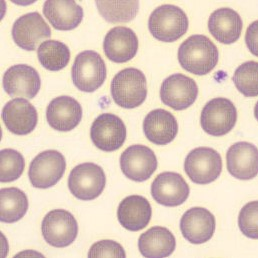 <p>NORMOCHROMIC</p>