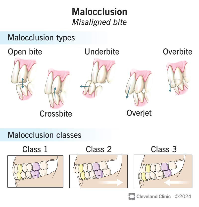 <p>Skeletal malocclusion: deviations in shape and dimension of mandible and maxilla</p><p>Dental malocclusion: deviations in positioning of individual teeth</p><p>Class I - mostly only teeth misaligned; arches ok</p><p>Class II -overjet, overbite, maxilla more forward</p><p>Class III - underbite, mandible more forward</p>