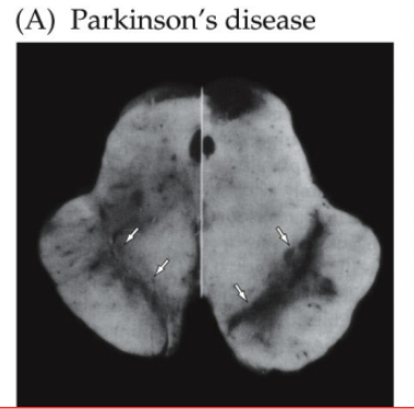 <p>Hypokinetic disorder; most common BG disease</p><ul><li><p>increased tonic inhibition of thalamus by BG; decreased disinhibition to thalamus —> overactivity og GPi</p></li><li><p>etiology: loss of dopaminergic neurons in SNpc, decreases the drive to the striatum </p></li><li><p>motor symptoms: bradykinesia, resting and pill-rolling tremor, cogwheel rigidity (freezing, falling, postural instability)</p></li><li><p>non-motor symptoms: dementia, depression</p></li><li><p>Tx: levodopa, DA agonists, Anti-cholinergics, deep brain stimulation</p></li></ul><p></p>
