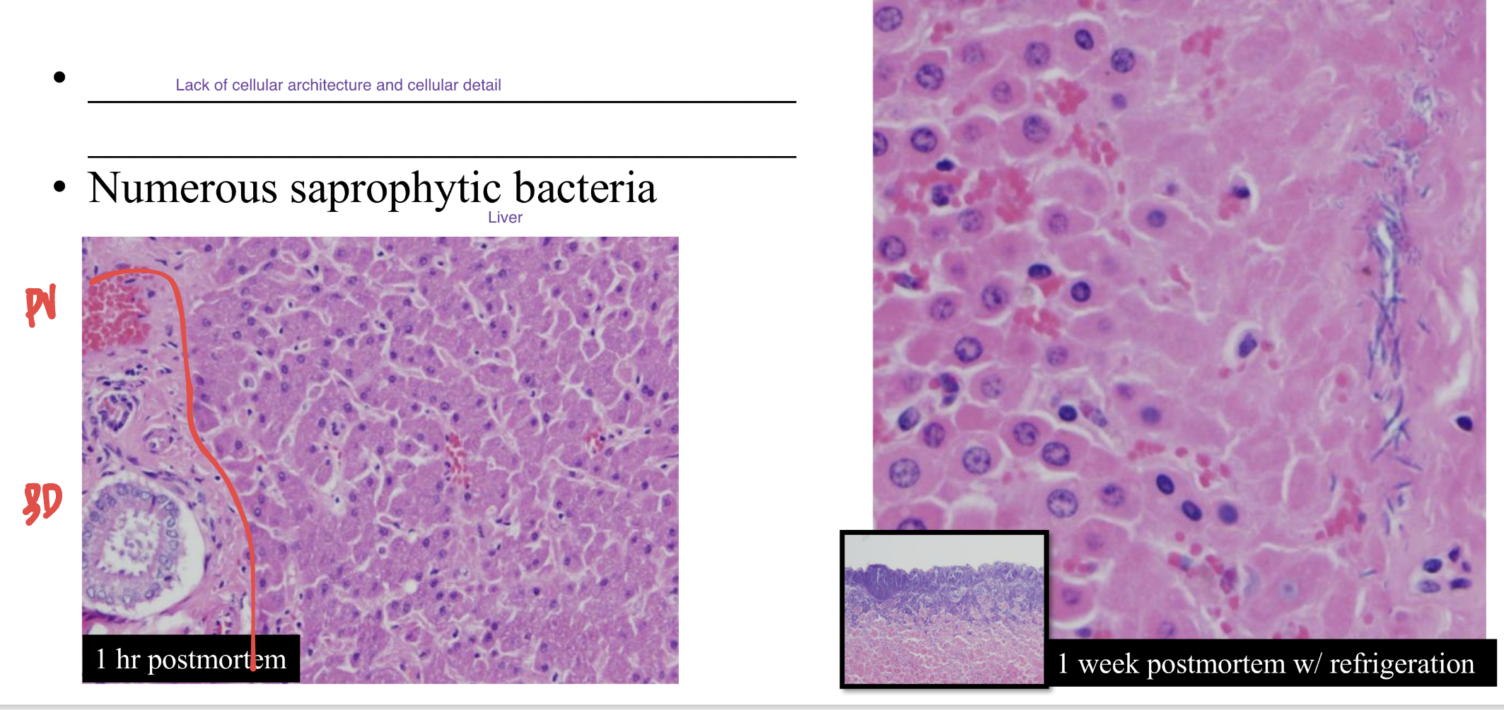 <p>lack of cell architecture and cell detail </p><p>numerous saprophytic bacteria </p>