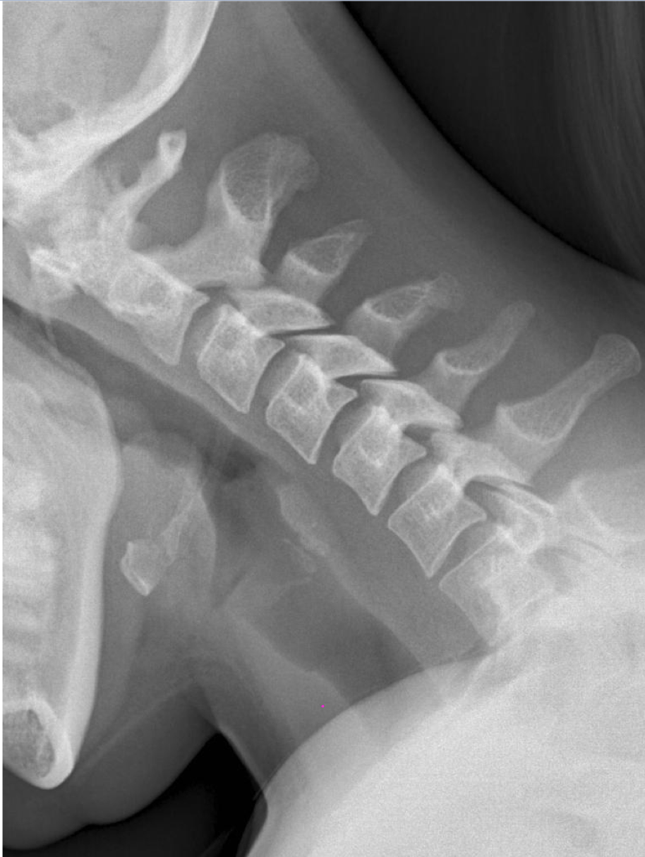 <p>What intersegmental motion should we see on a normal flexion film</p>
