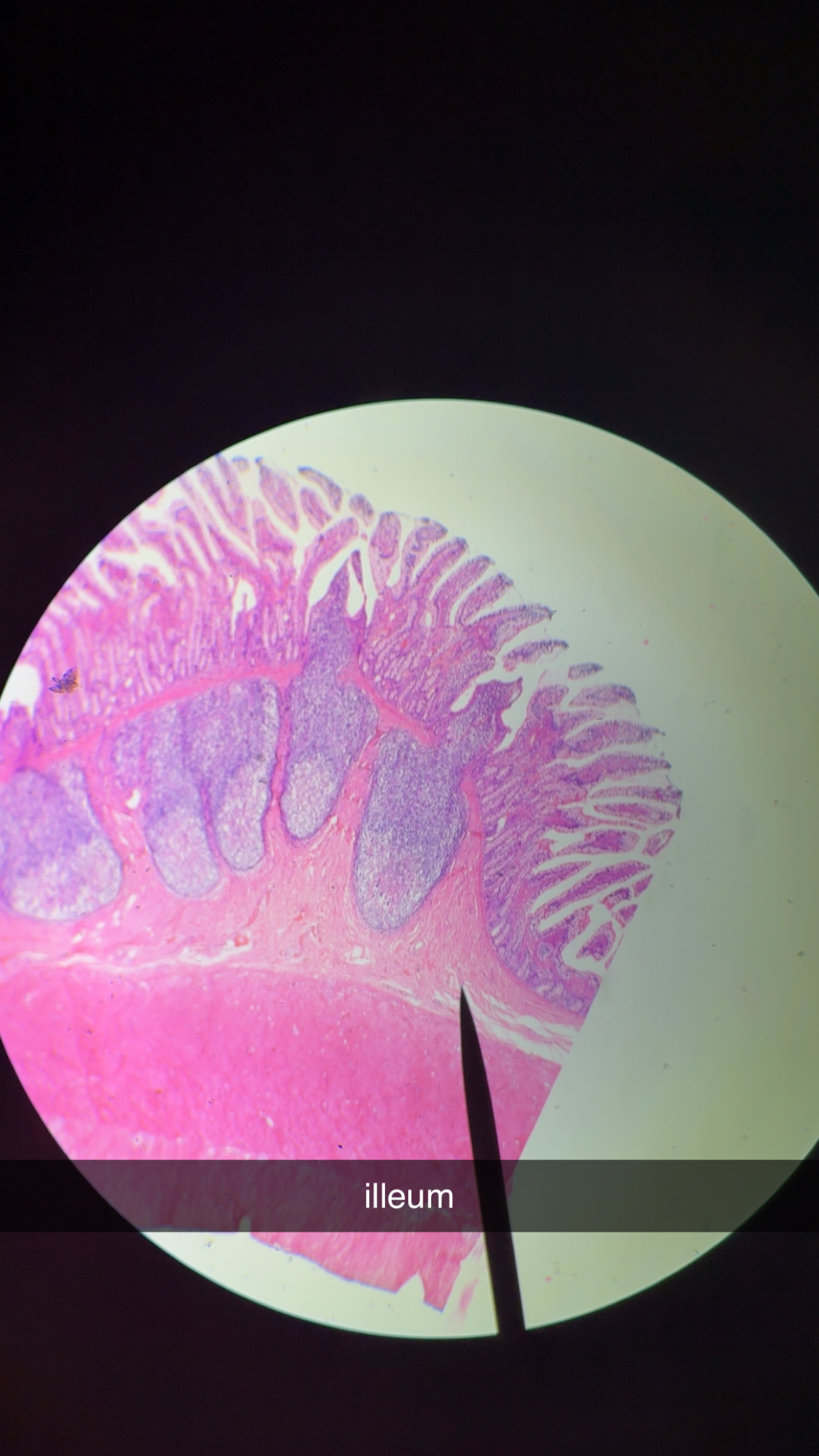 <p>Peters Patches- lymphoid follicles that inc along length of canal</p><p></p><p>Mucosa-Associated Lymphoid Tissues (MALT) </p><p></p><p>villi are shorter </p>